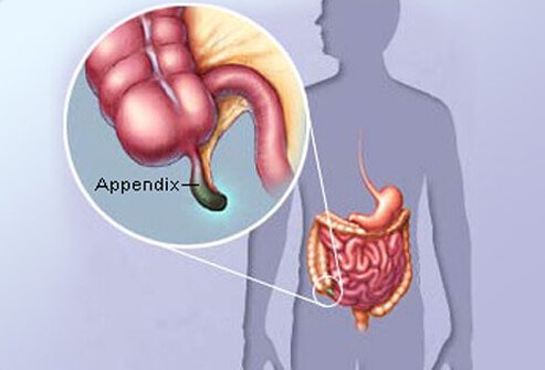 appendicitis