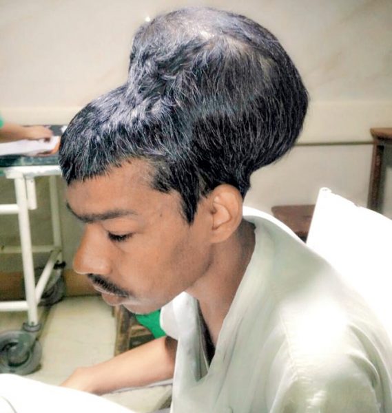 brain tumour a