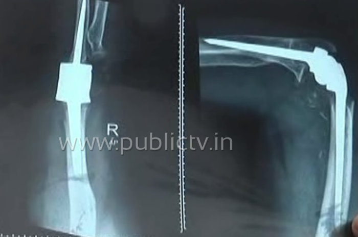 bly operation 2