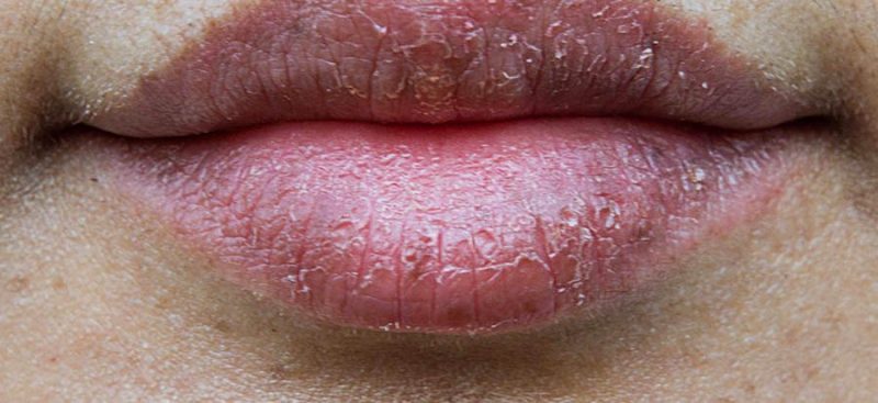 Lip Health Tips 1