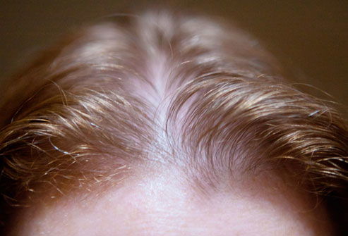 webmd rf photo of thinning hairline woman