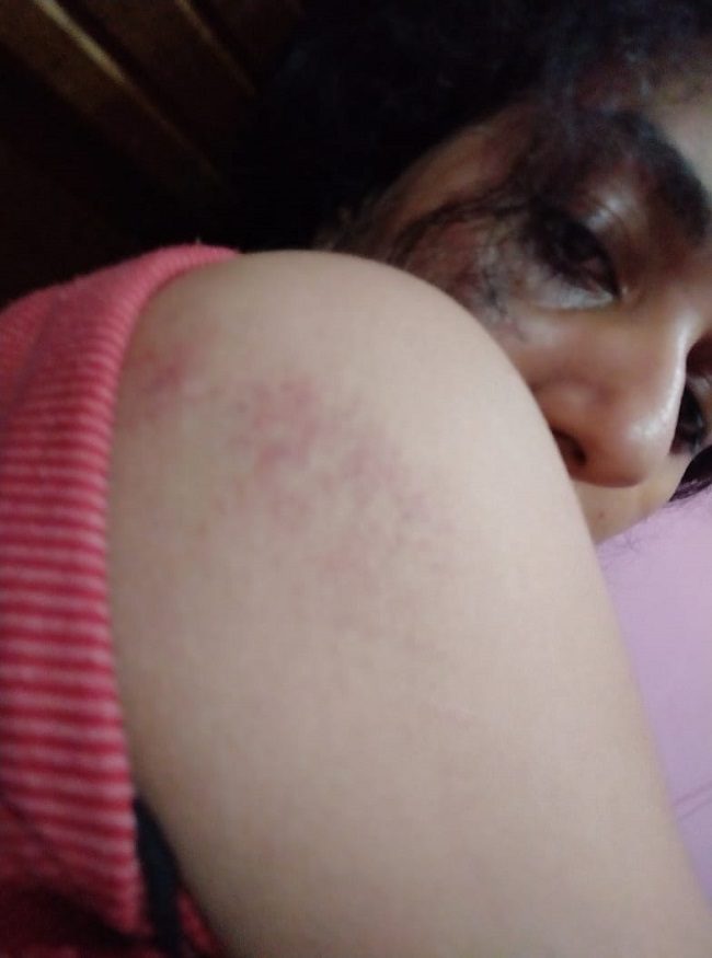 Vismaya injury photo 21062021 650 medium