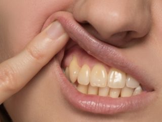 yellow teeth2