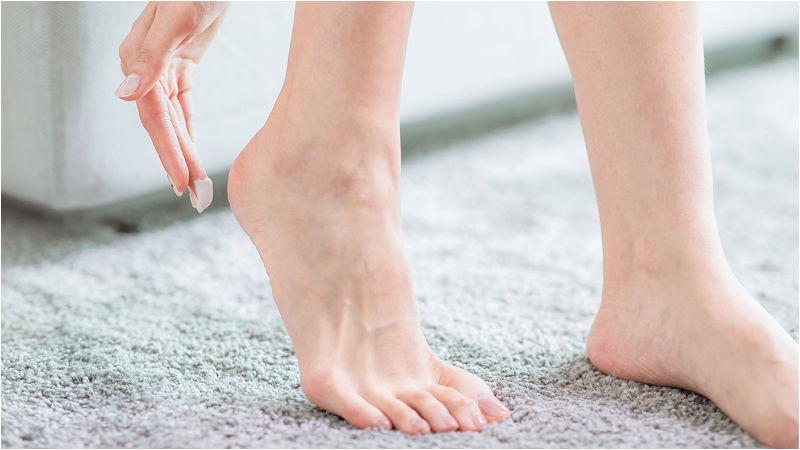 cracked heels 2