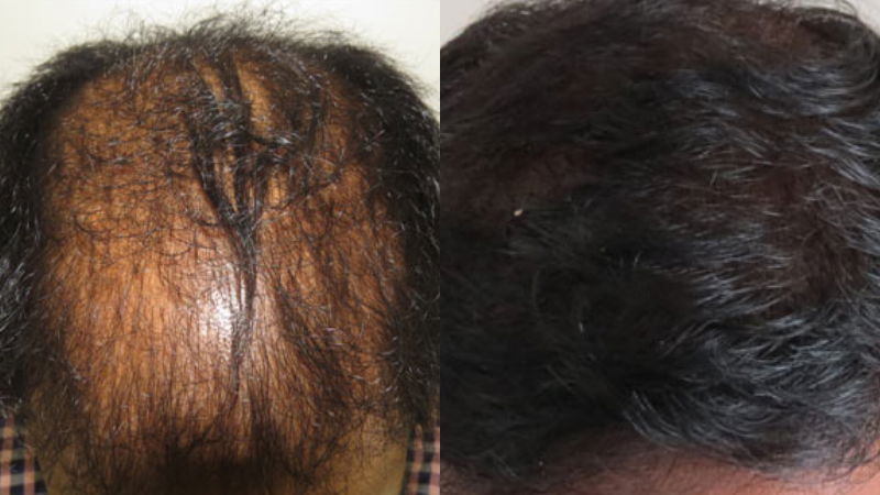 Hair Transplant