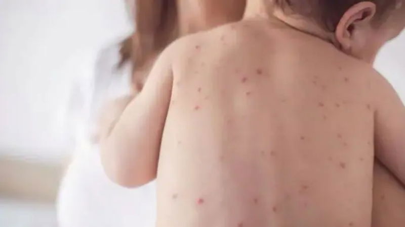 Measles 1