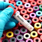 measles