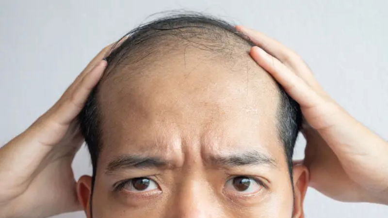 Hair Transplant bald hair 1