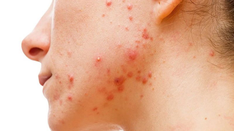 ACNE