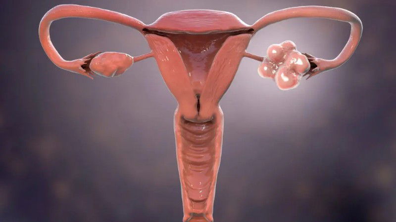 PCOS