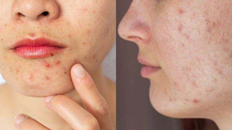 Pimple